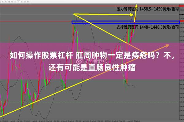 如何操作股票杠杆 肛周肿物一定是痔疮吗？不，还有可能是直肠良性肿瘤